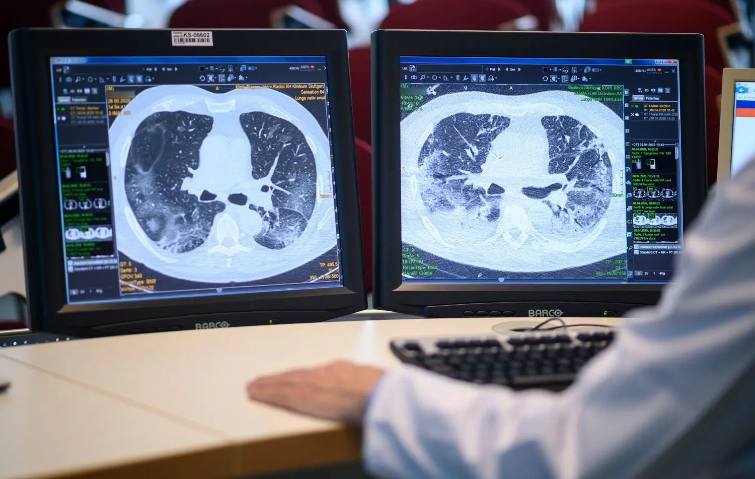 Ein Arzt am Klinikum Stuttgart betrachtet auf zwei Monitoren Aufnahmen der Lunge eines Covid-19-Patienten.