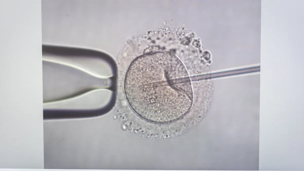 Auf einem Bildschirm in der Praxis Kinderwunsch Bremen in Bremen-Schwachhausen ist das Mikroskopbild einer Intrazytoplasmatischen Spermieninjektion (ICSI) zu sehen, bei der mit einer Pipette Spermien in eine Eizelle injiziert werden.