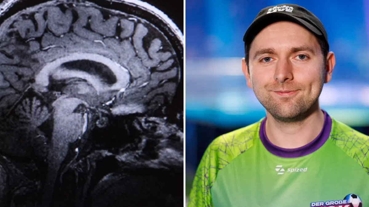Hirnaneurysmen bleiben oft unbemerkt – so auch im Fall von Streamer SkylineTV.